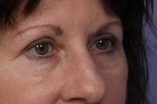 Eyelid Surgery Before & After Image