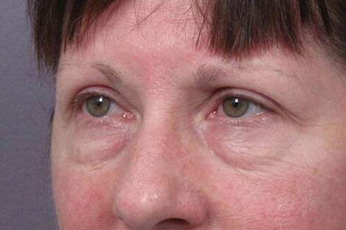 Eyelid Surgery Before & After Image