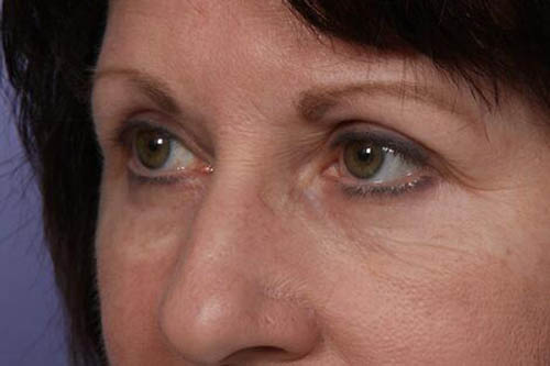 Eyelid Surgery Before & After Image