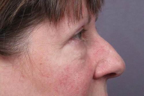 Eyelid Surgery Before & After Image