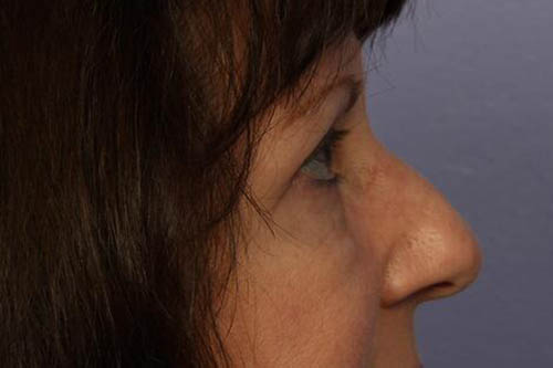 Eyelid Surgery Before & After Image