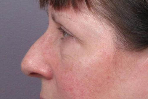 Eyelid Surgery Before & After Image