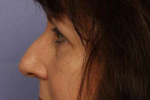 Eyelid Surgery Before & After Image