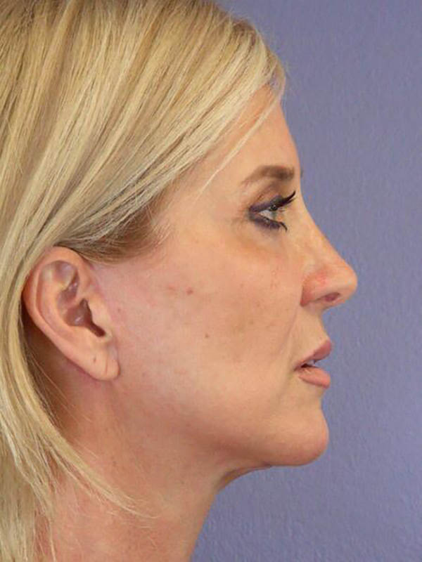 Eyelid Surgery Before & After Image