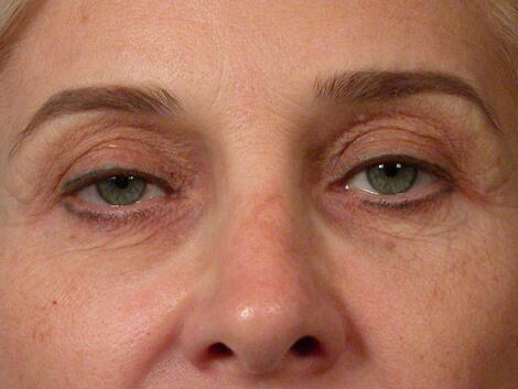 Eyelid Surgery Before & After Image