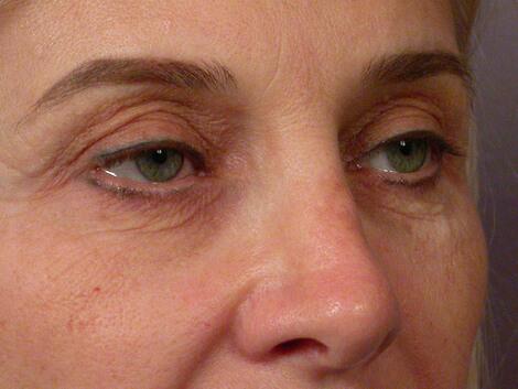 Eyelid Surgery Before & After Image