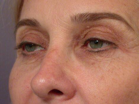 Eyelid Surgery Before & After Image