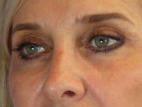 Eyelid Surgery Before & After Image