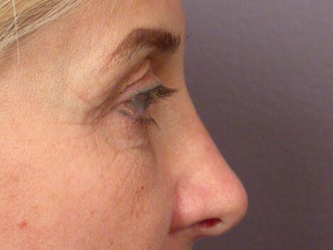 Eyelid Surgery Before & After Image