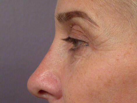 Eyelid Surgery Before & After Image