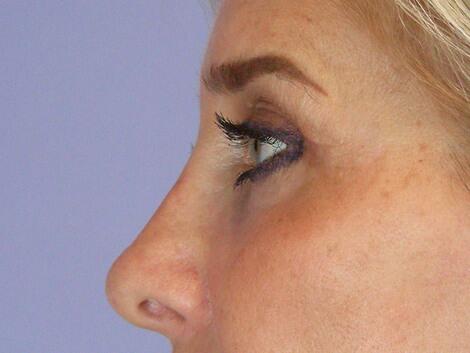 Eyelid Surgery Before & After Image