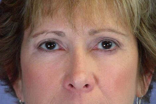 Eyelid Surgery Before & After Image