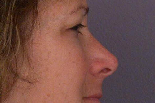 Eyelid Surgery Before & After Image