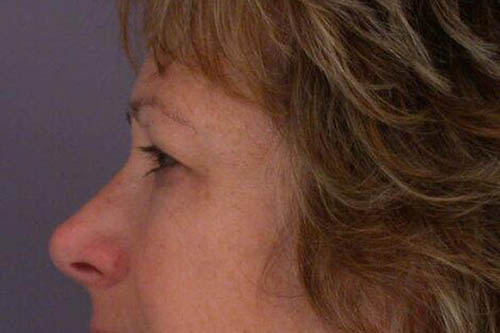 Eyelid Surgery Before & After Image