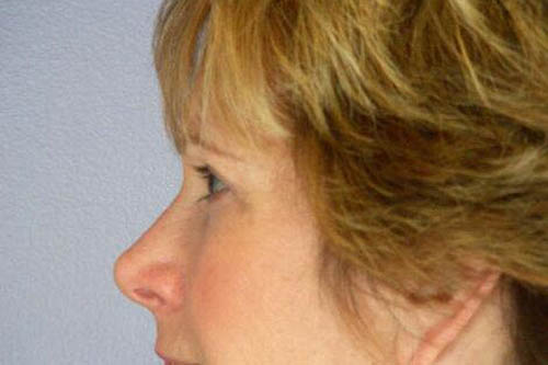 Eyelid Surgery Before & After Image