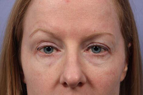 Eyelid Surgery Before & After Image