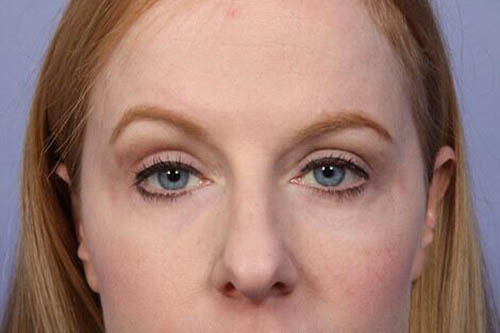 Eyelid Surgery Before & After Image