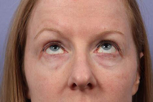 Eyelid Surgery Before & After Image