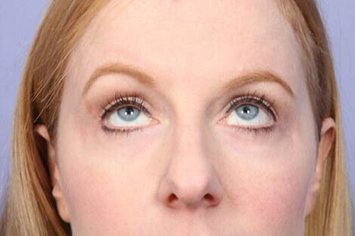 Eyelid Surgery Before & After Image