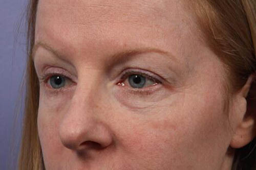 Eyelid Surgery Before & After Image