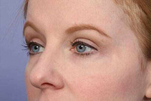 Eyelid Surgery Before & After Image