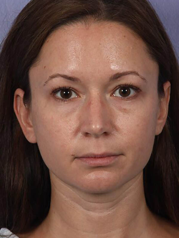 Eyelid Surgery Before & After Image