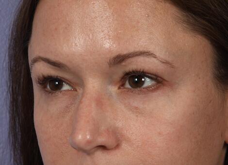 Eyelid Surgery Before & After Image