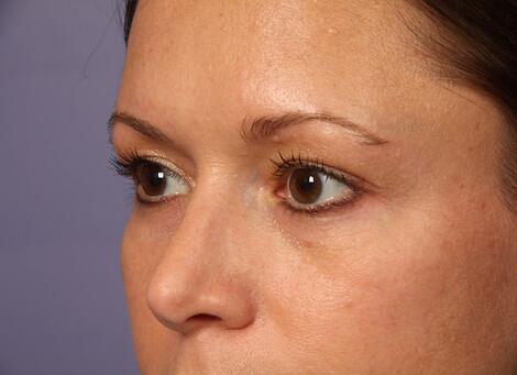 Eyelid Surgery Before & After Image