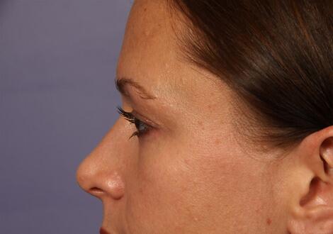 Eyelid Surgery Before & After Image