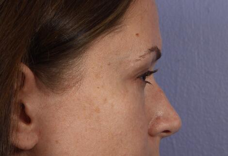 Eyelid Surgery Before & After Image