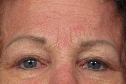 Eyelid Surgery Before & After Image