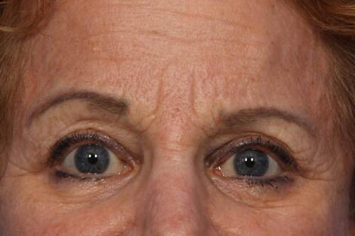 Eyelid Surgery Before & After Image