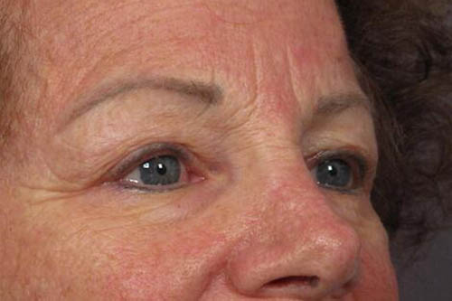 Eyelid Surgery Before & After Image