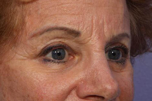 Eyelid Surgery Before & After Image