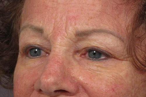 Eyelid Surgery Before & After Image