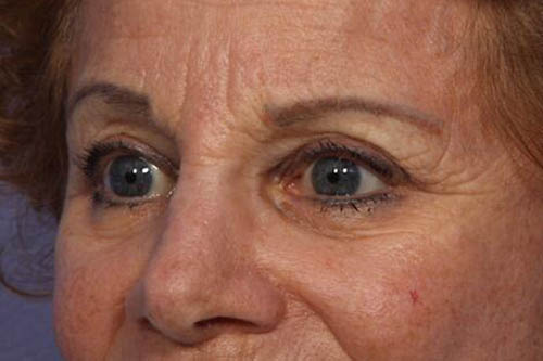 Eyelid Surgery Before & After Image