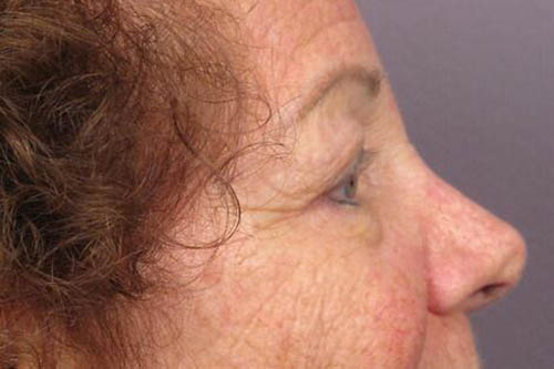 Eyelid Surgery Before & After Image