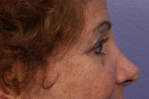 Eyelid Surgery Before & After Image