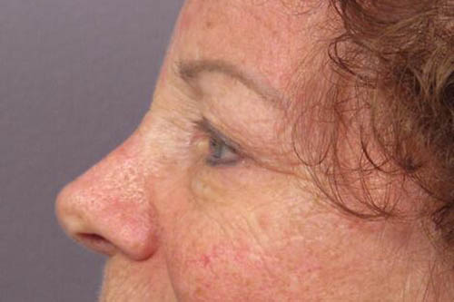 Eyelid Surgery Before & After Image