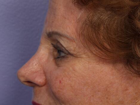 Eyelid Surgery Before & After Image