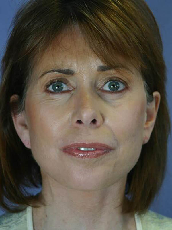 Eyelid Surgery Before & After Image