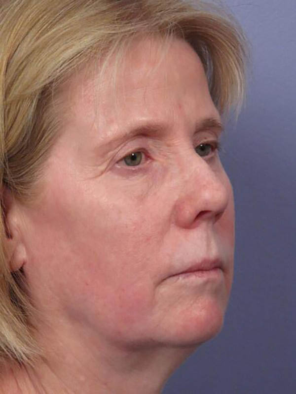 Eyelid Surgery Before & After Image