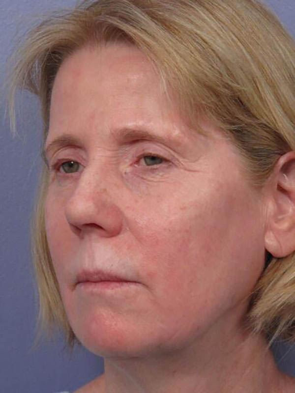 Eyelid Surgery Before & After Image