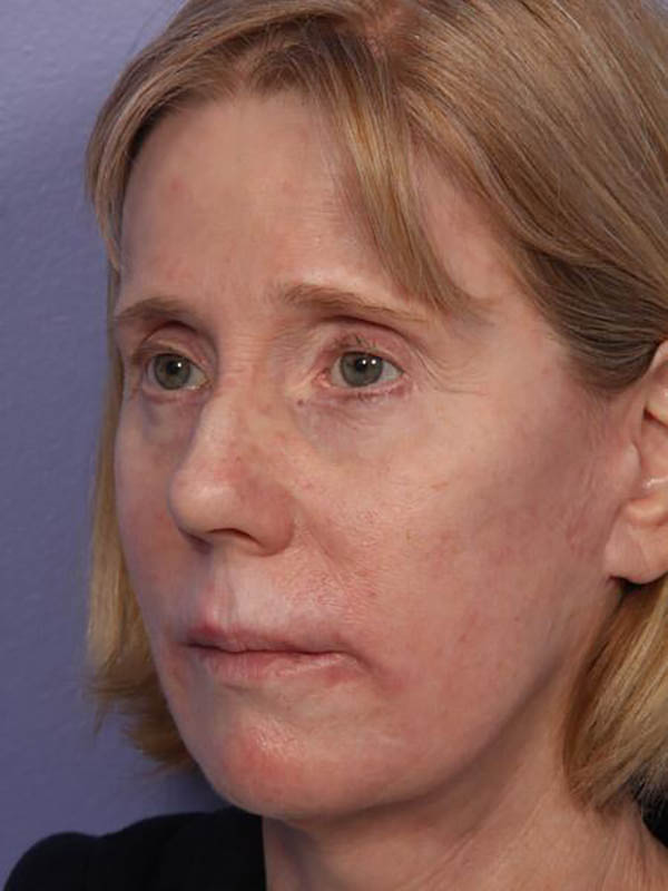 Eyelid Surgery Before & After Image