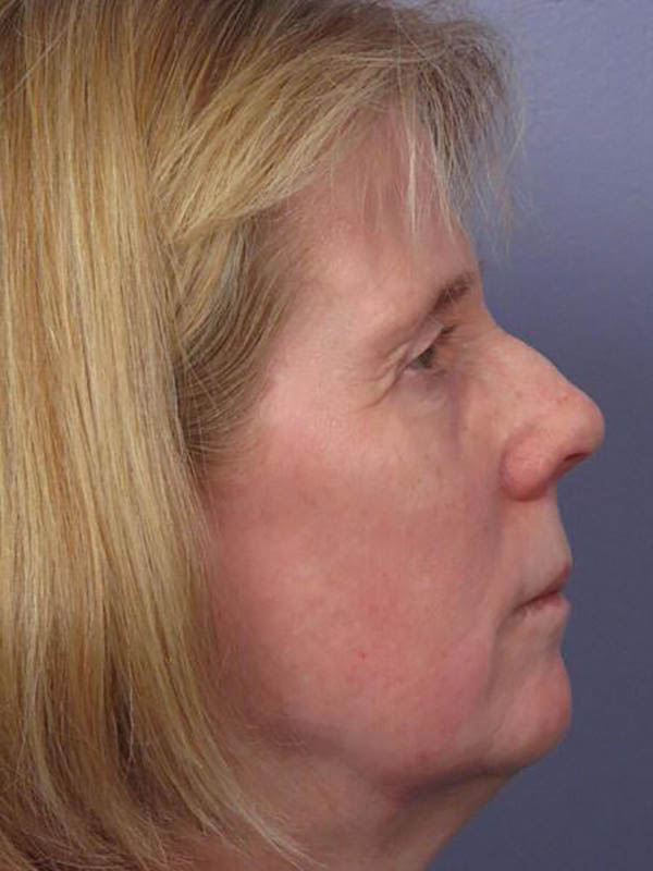 Eyelid Surgery Before & After Image