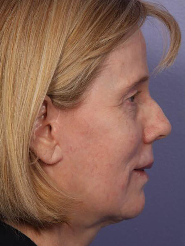 Eyelid Surgery Before & After Image