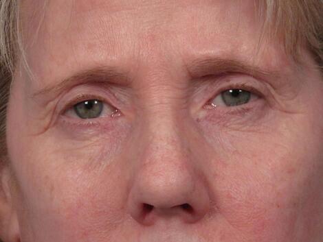 Eyelid Surgery Before & After Image