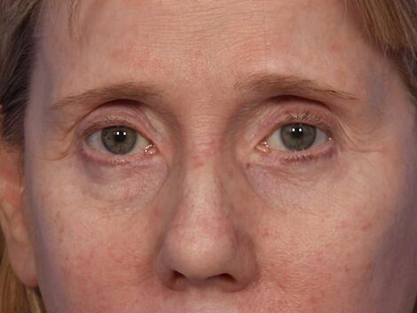 Eyelid Surgery Before & After Image