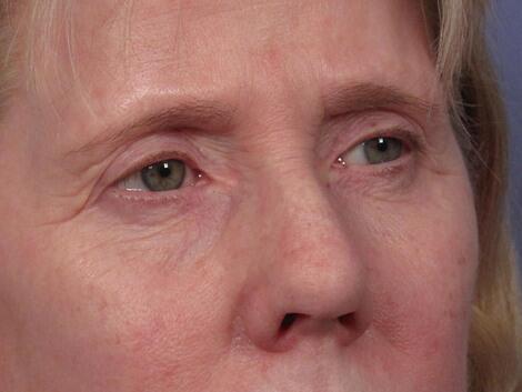 Eyelid Surgery Before & After Image