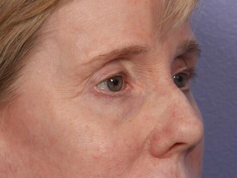 Eyelid Surgery Before & After Image